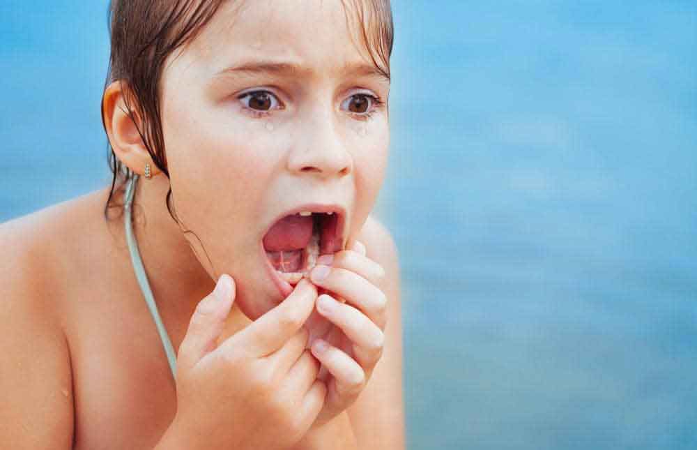 Vida Saludable Rotura de dientes en niños: ¿qué hacer?