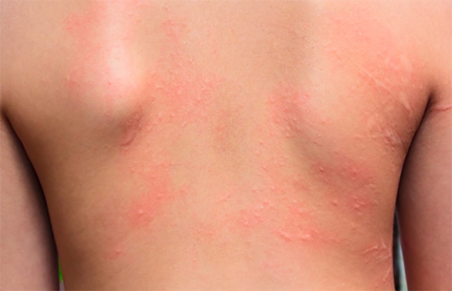 Frente a la dermatitis atópica mucha hidratación