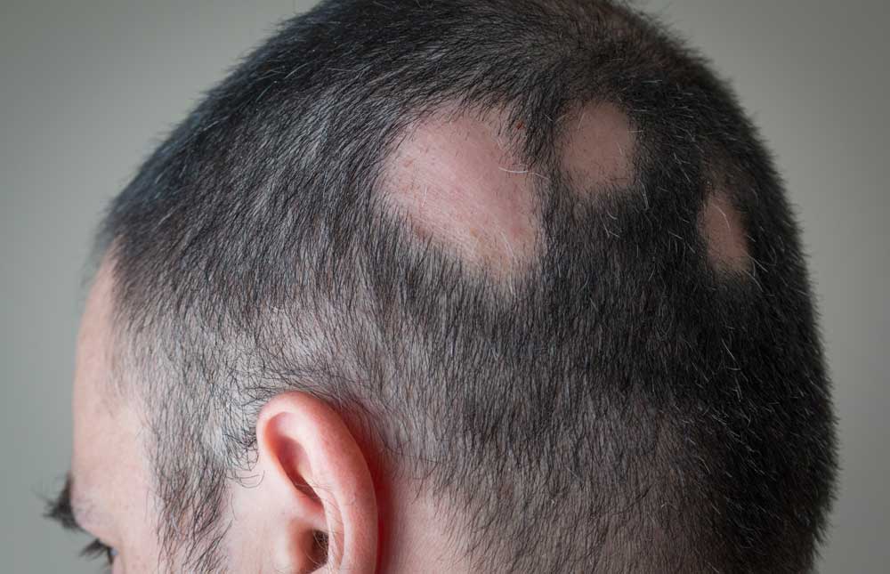 El estrés y la alopecia areata 